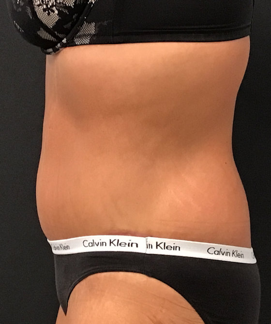 tummy tuck