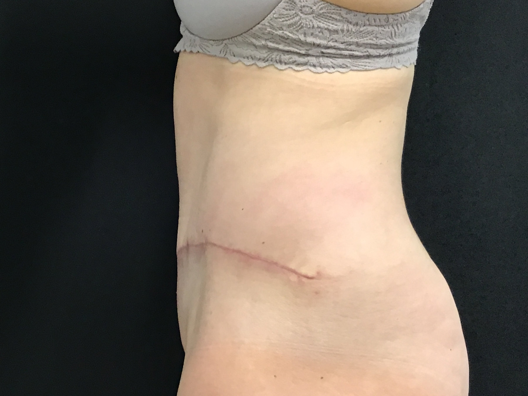 Tummy Tuck with Diastasis Repair