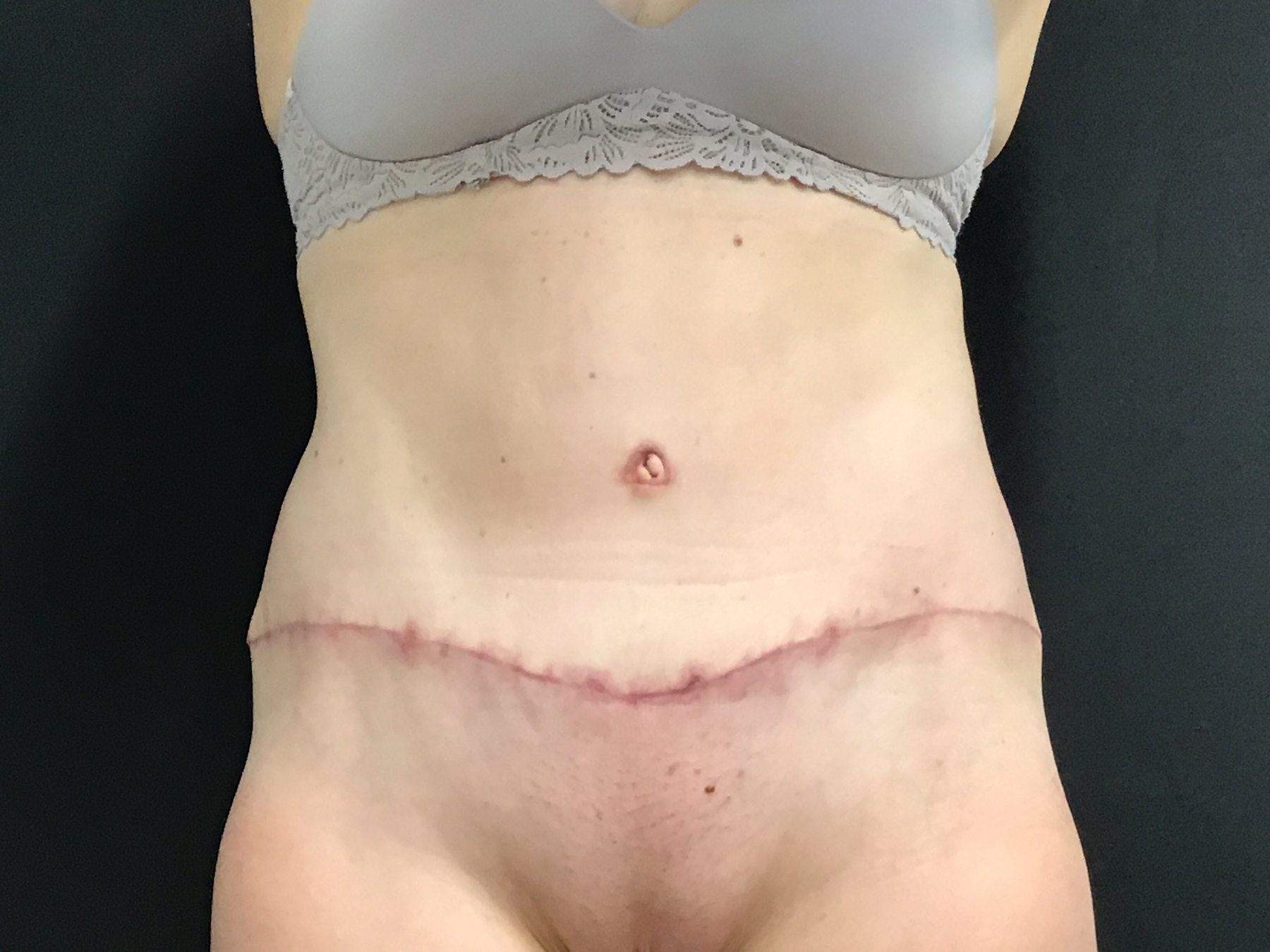 Tummy Tuck with Diastasis Repair