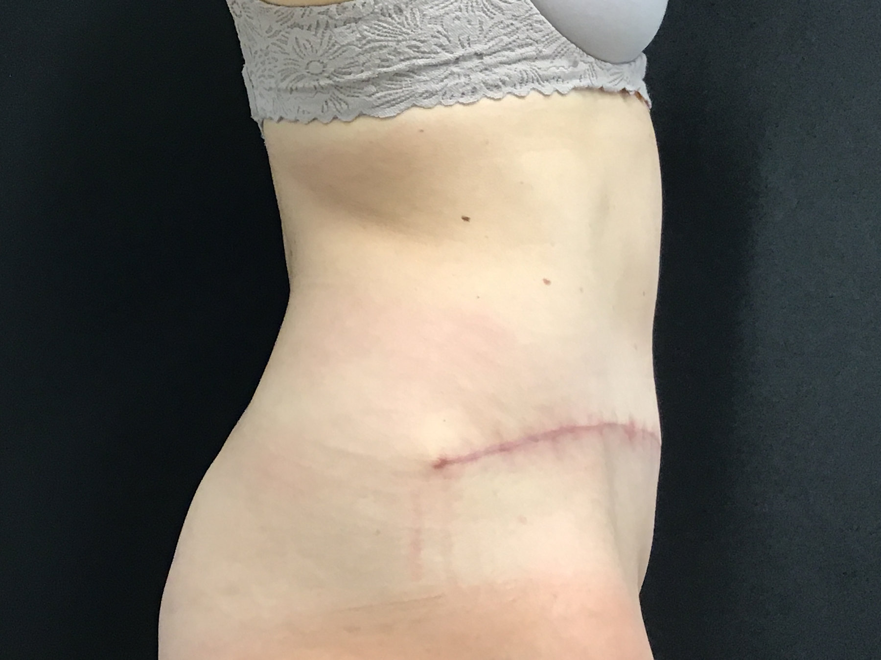 Tummy Tuck with Diastasis Repair