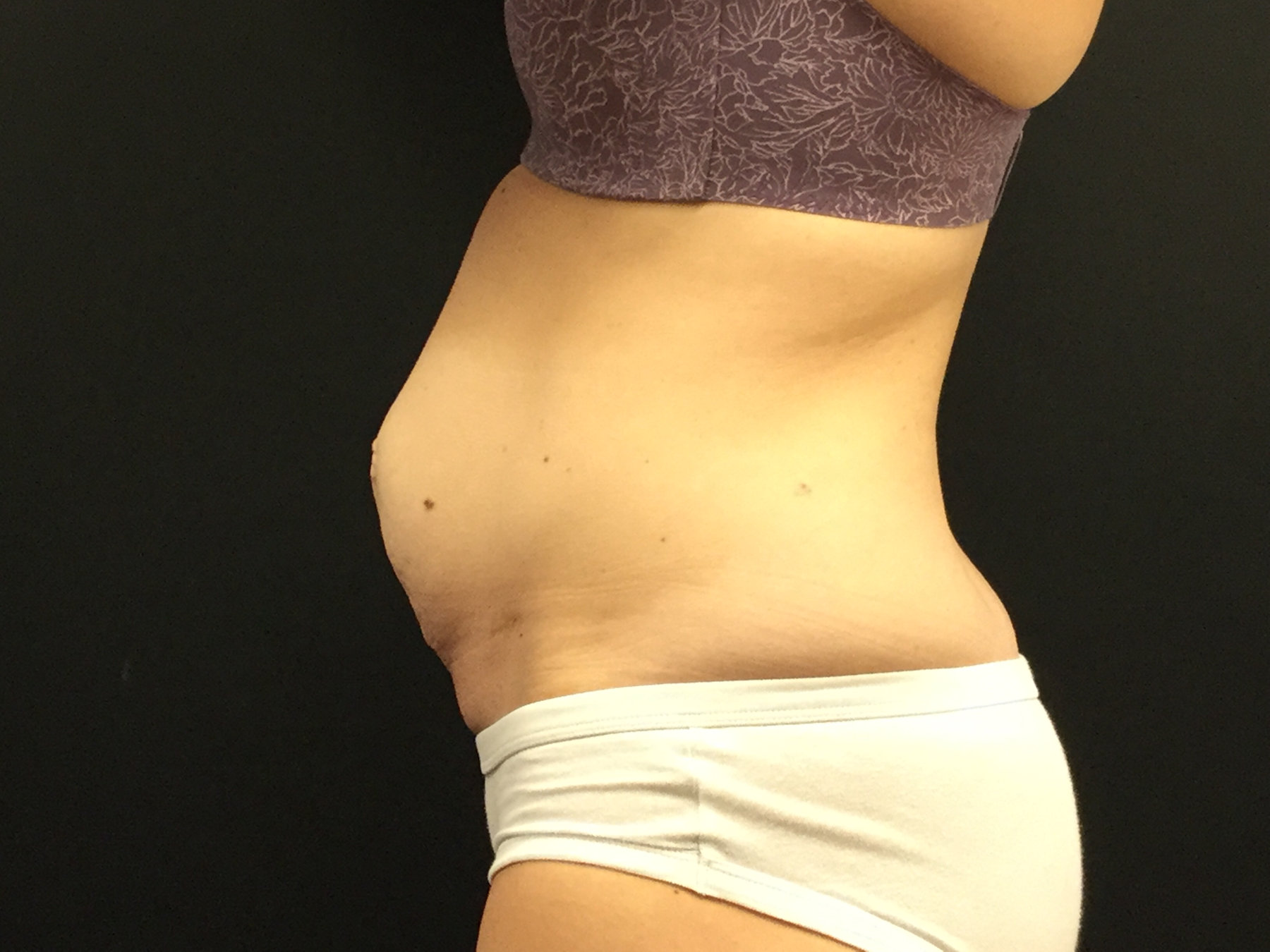 Tummy Tuck with Diastasis Repair