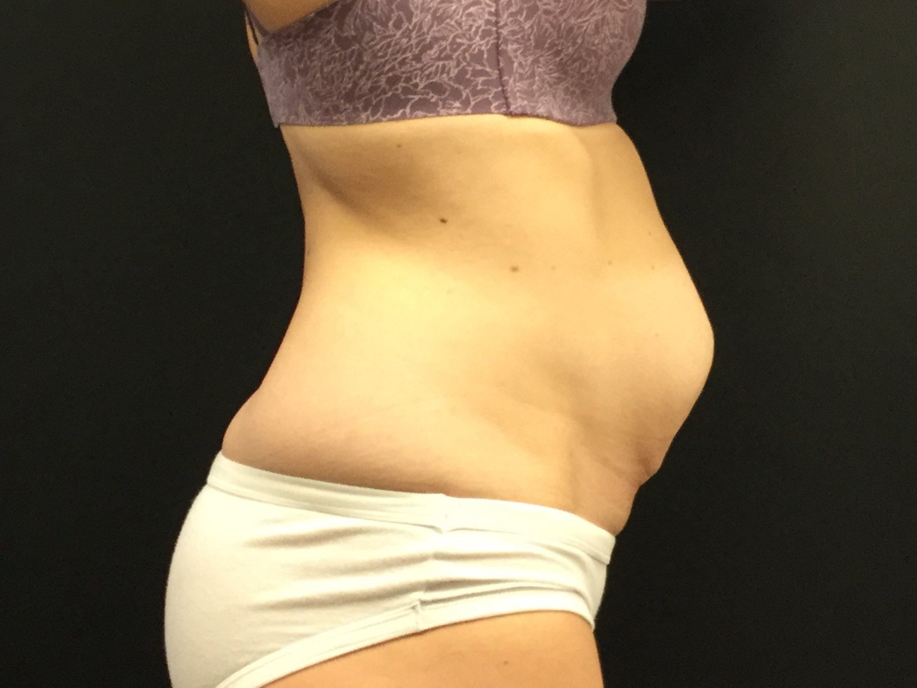 Tummy Tuck with Diastasis Repair