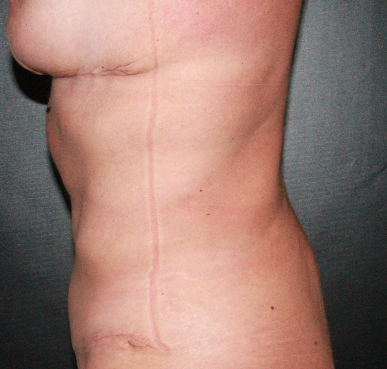Fleur-de-Lis Tummy Tuck with Liposuction