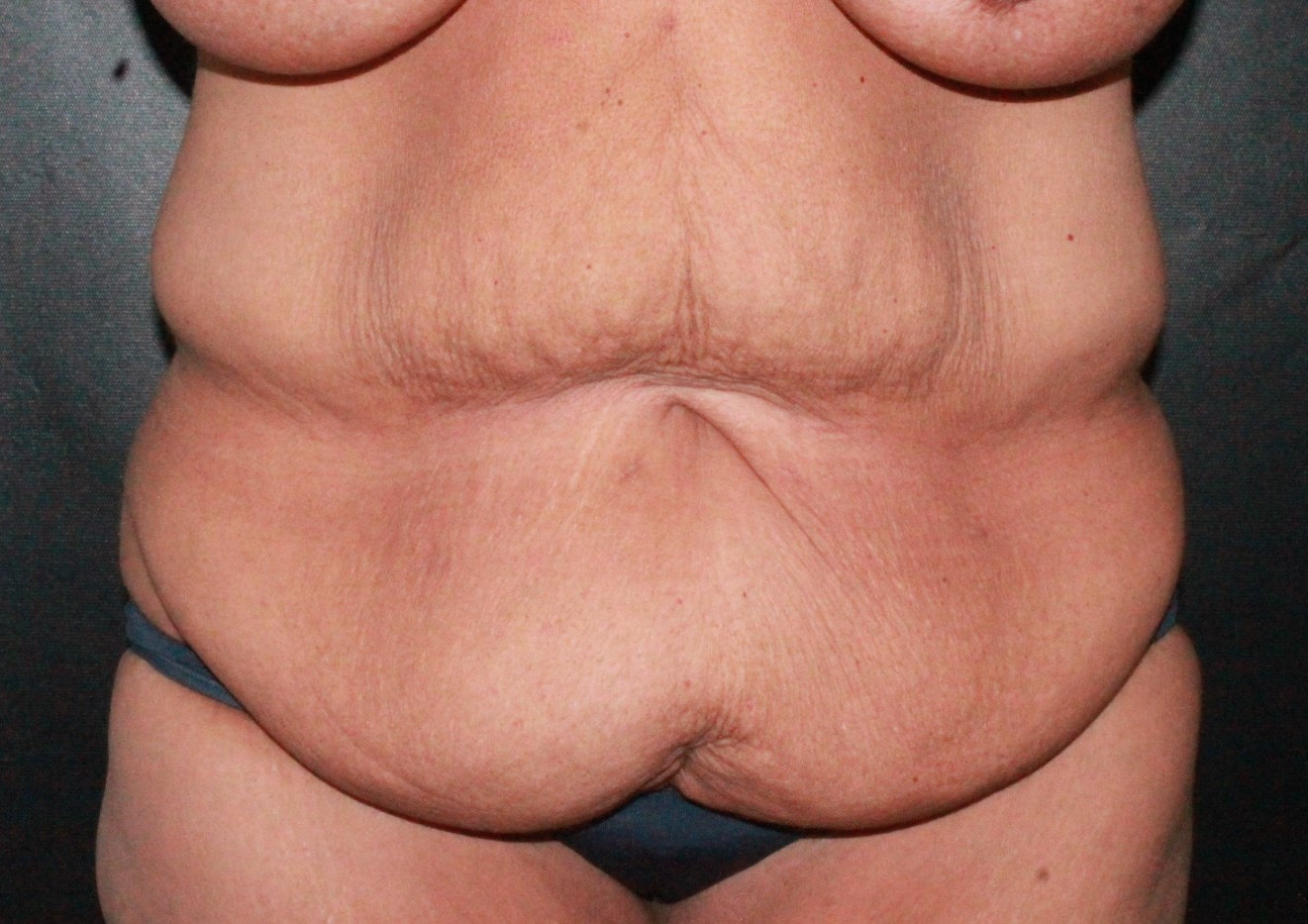 Fleur-de-Lis Tummy Tuck with Liposuction