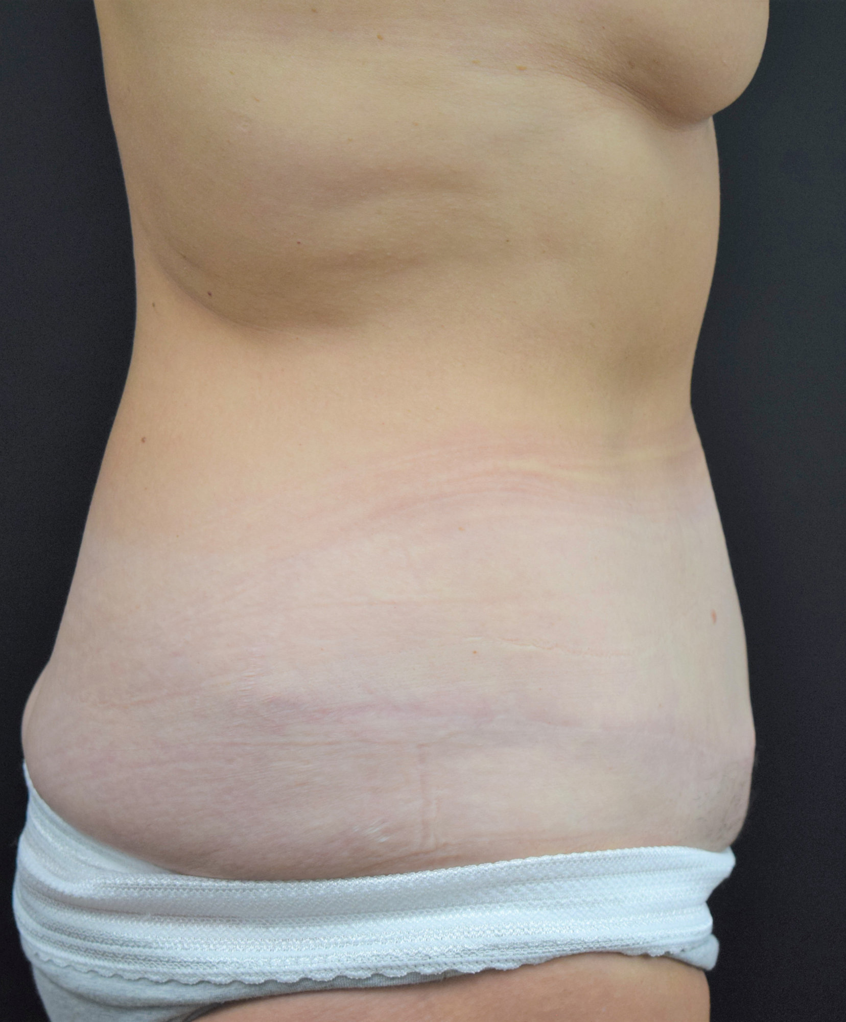 tummy tuck