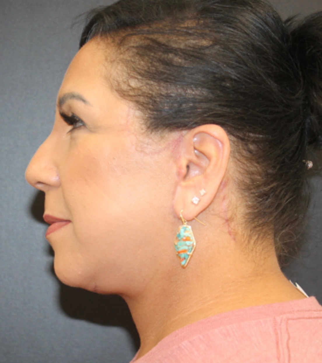 Face Lift