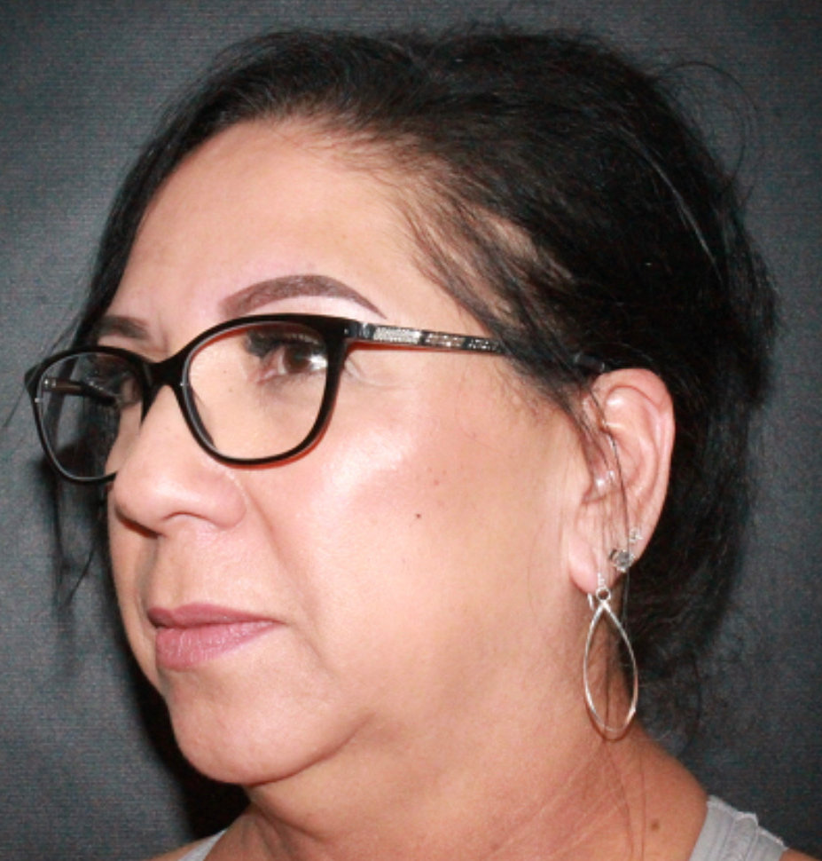 Face Lift