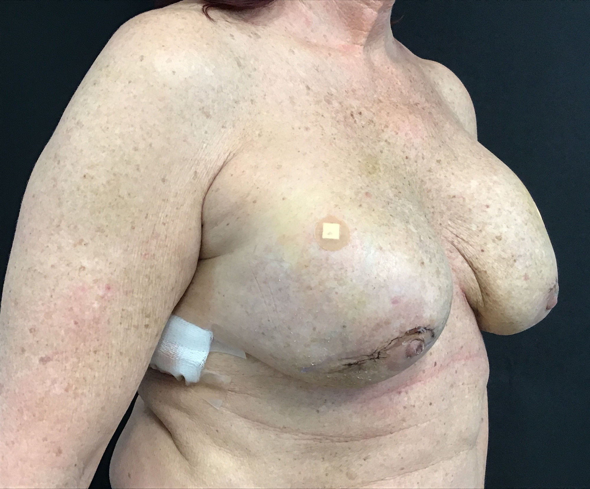 breast reconstruction