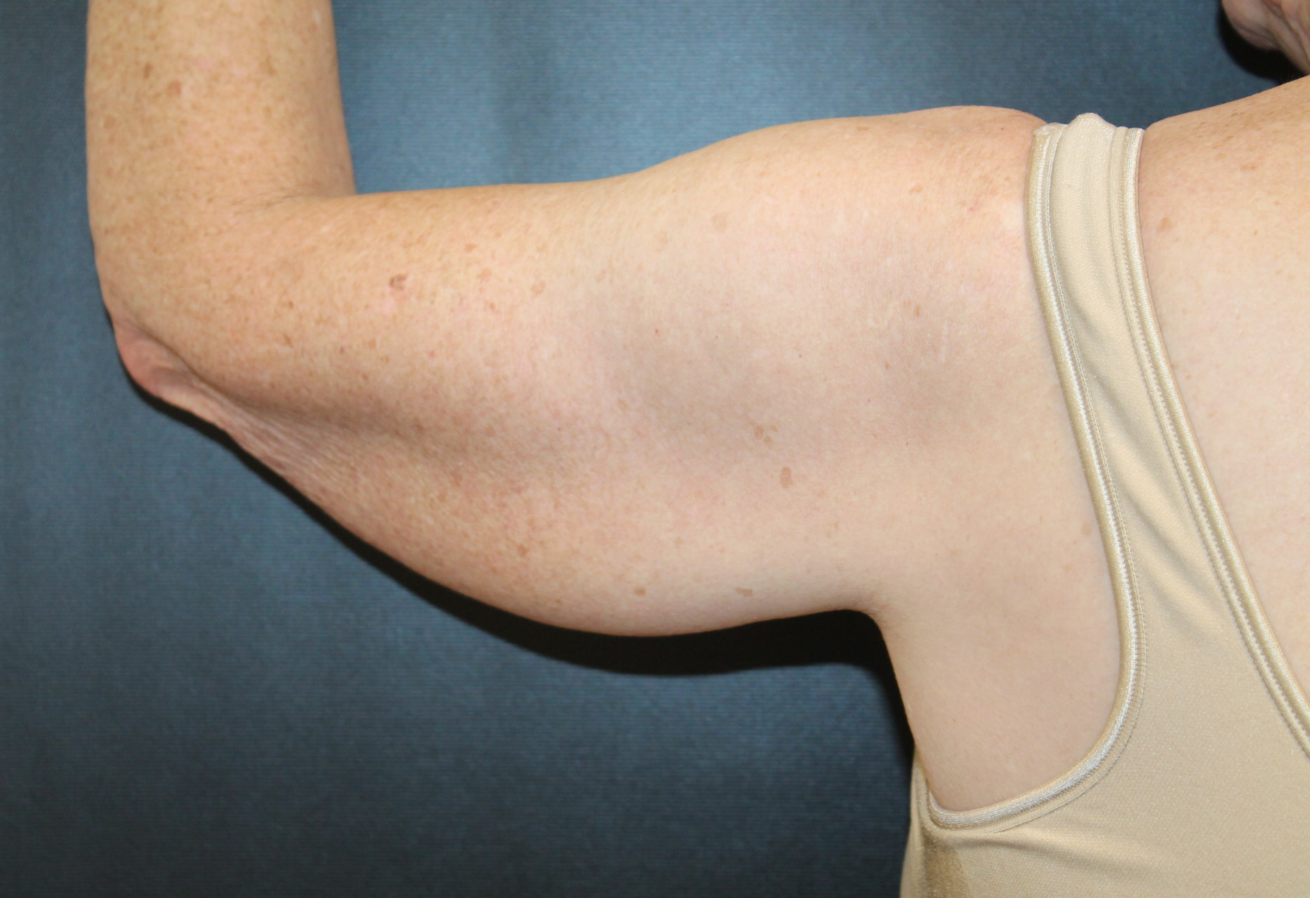 arm lift