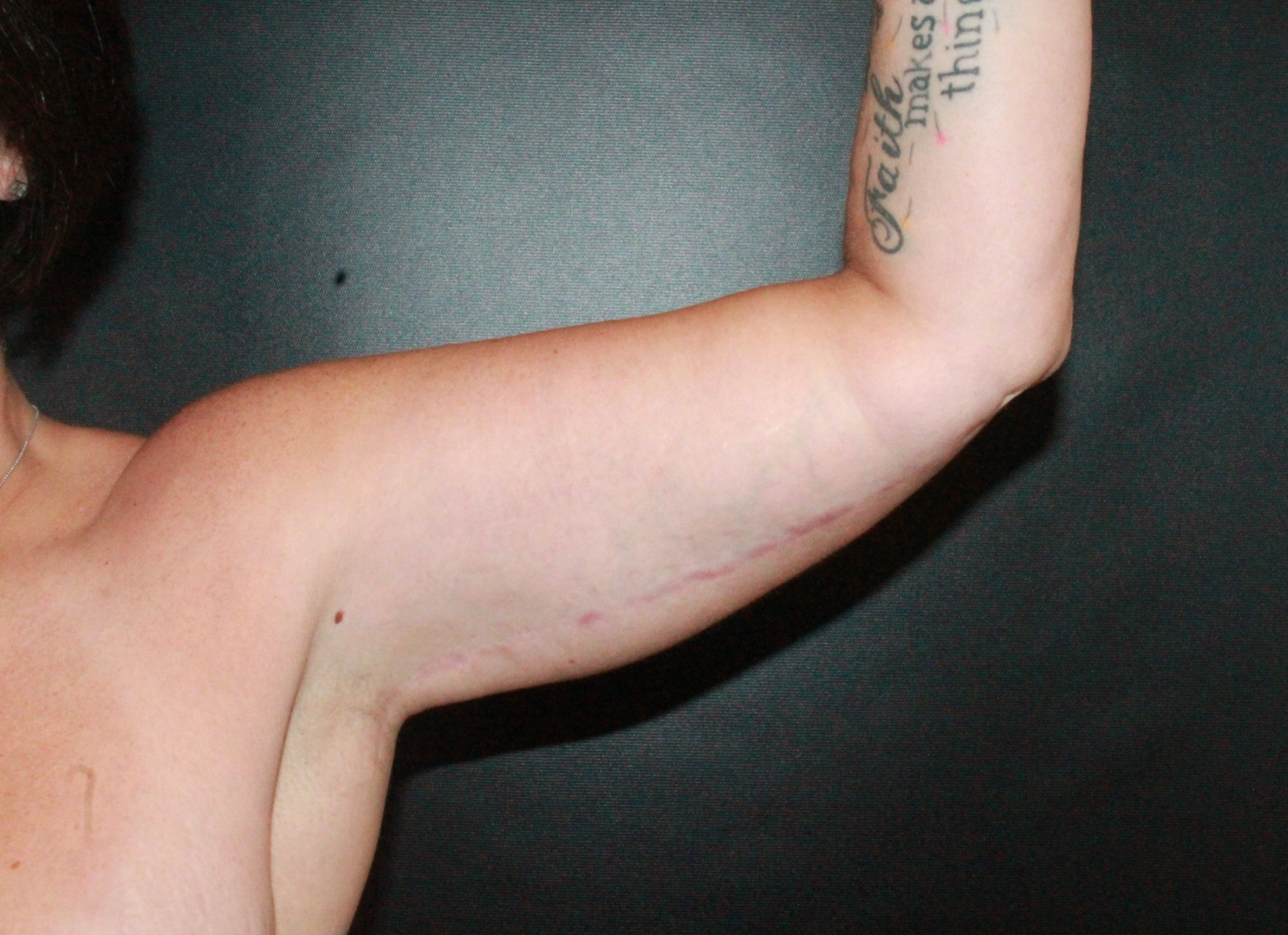 arm lift