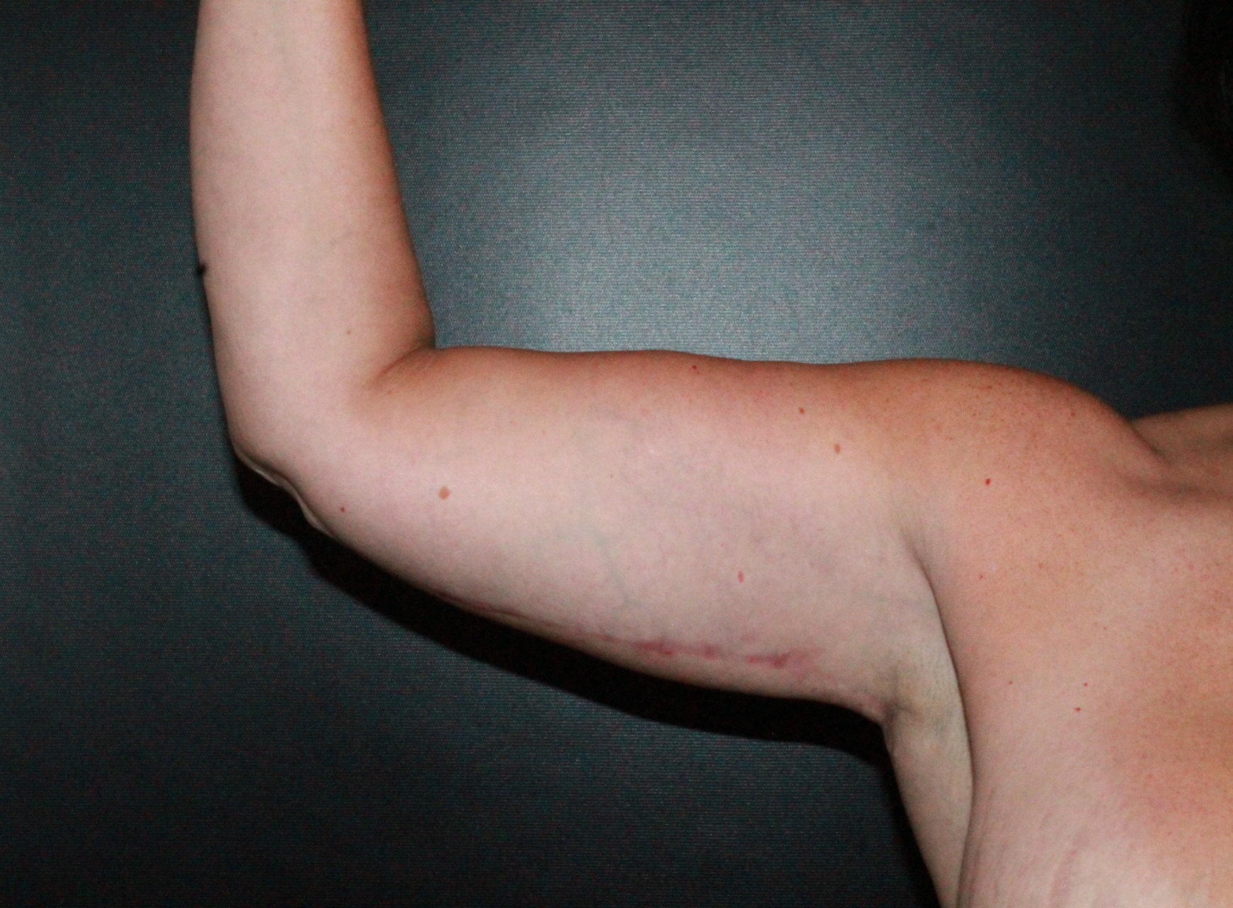 arm lift