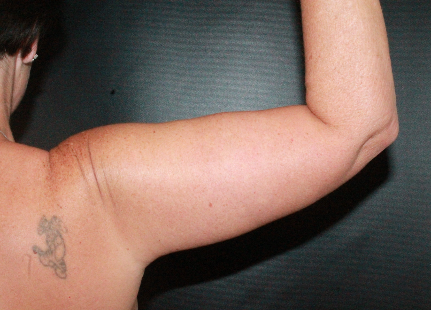arm lift