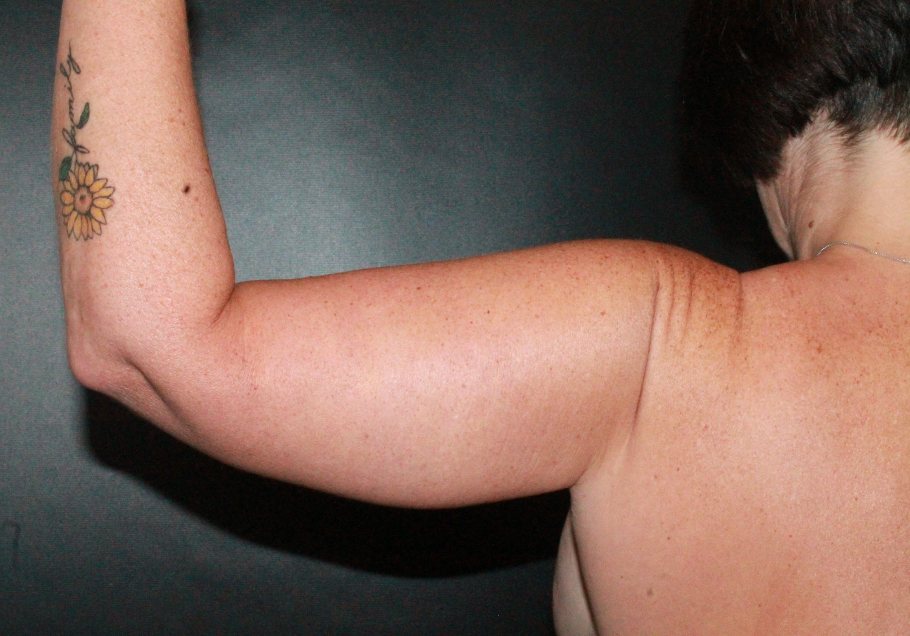 arm lift