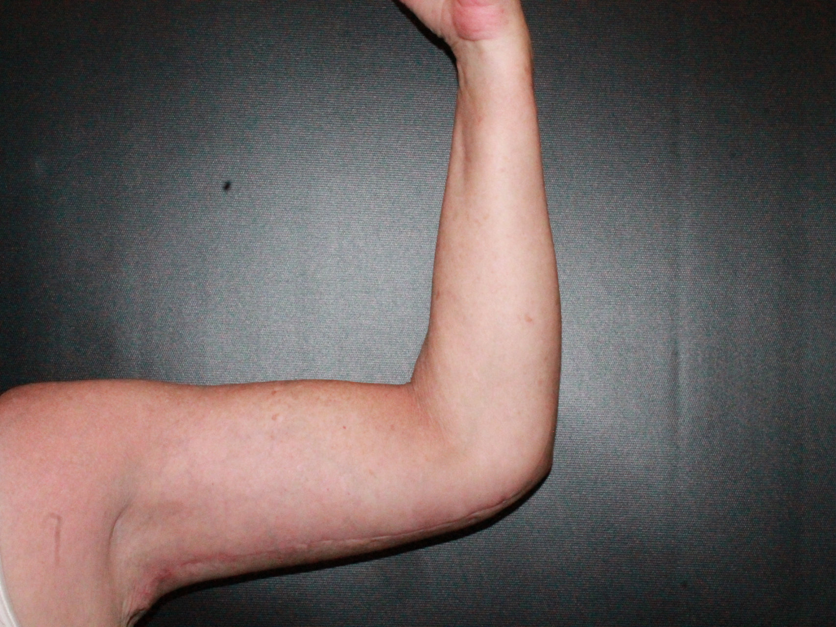 arm lift