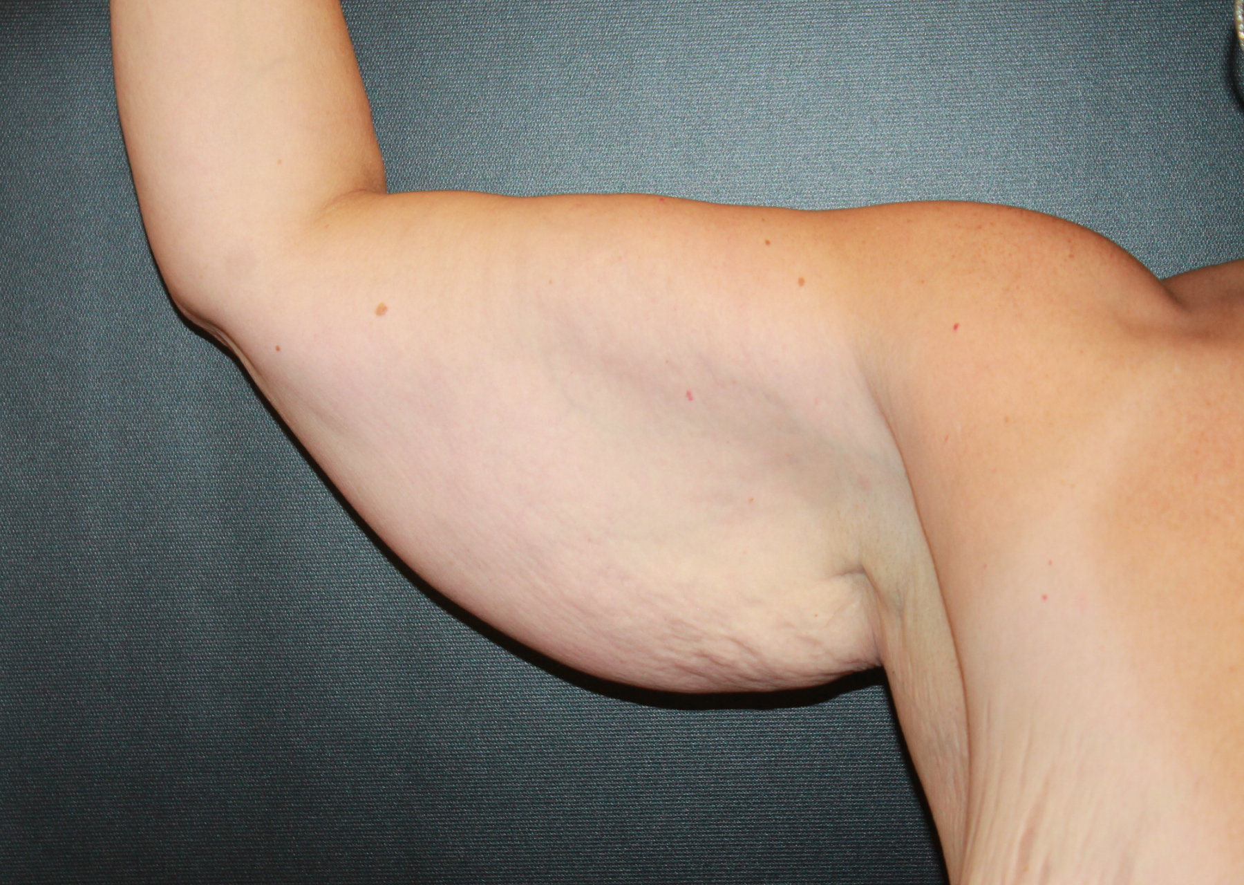 arm lift