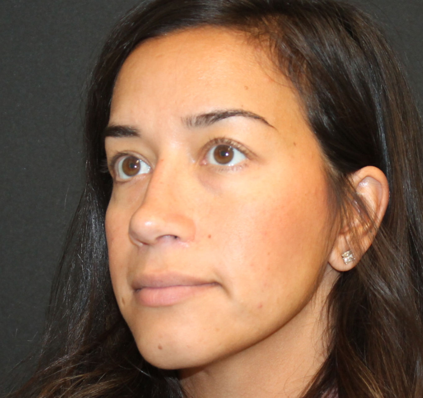 septorhinoplasty