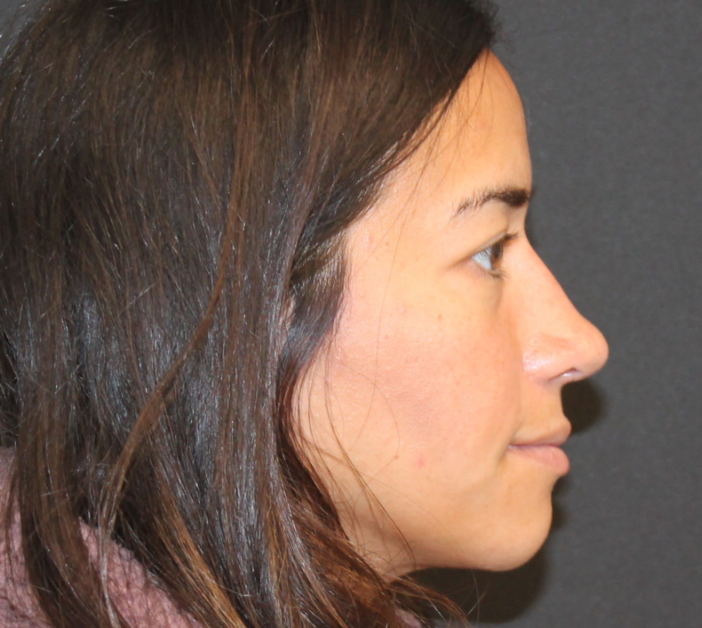 septorhinoplasty