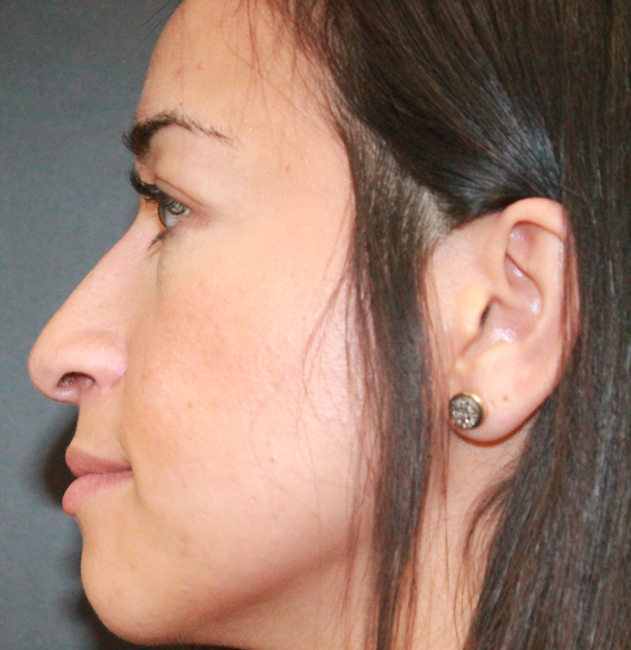 septorhinoplasty