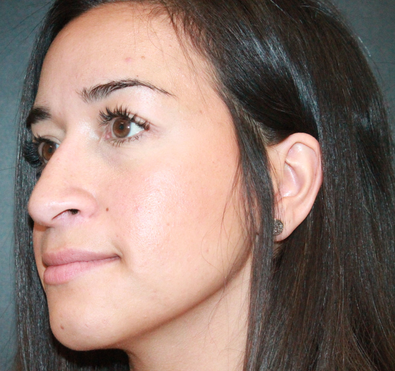 septorhinoplasty