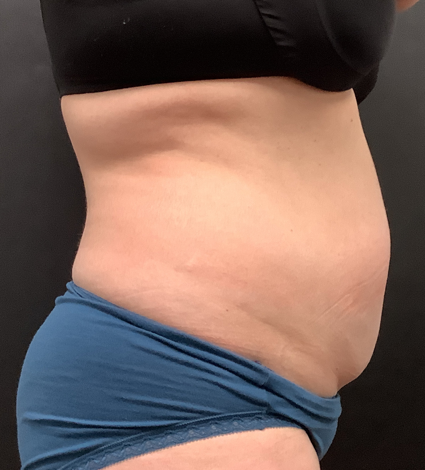 tummy tuck with liposuction