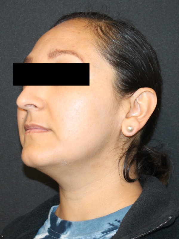 septorhinoplasty