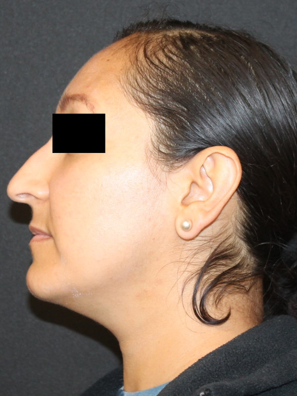 septorhinoplasty