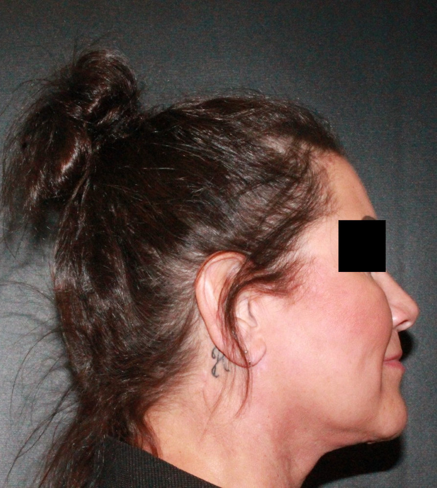 Facelift