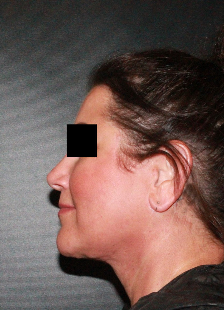 Facelift