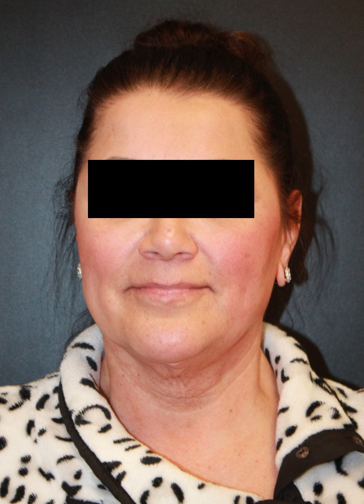 Facelift