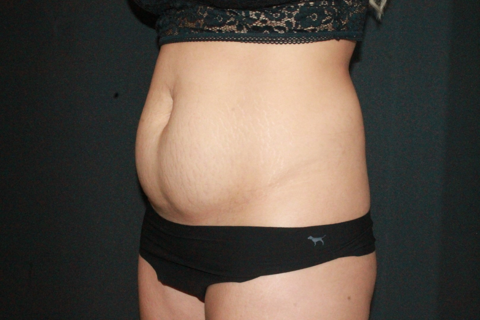 Mini Tummy Tuck