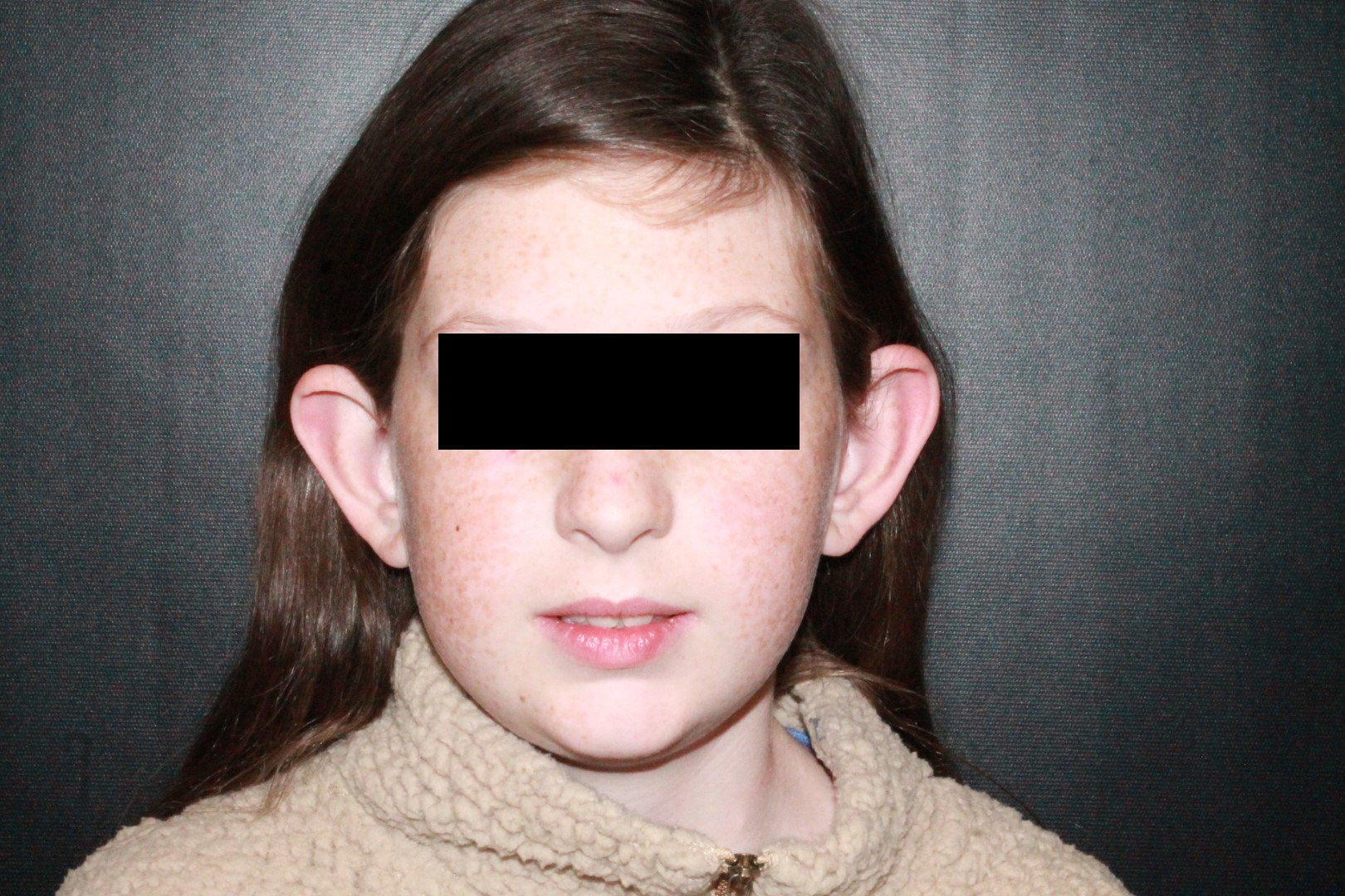 Otoplasty