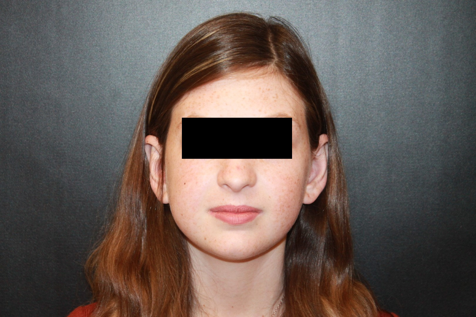 Otoplasty