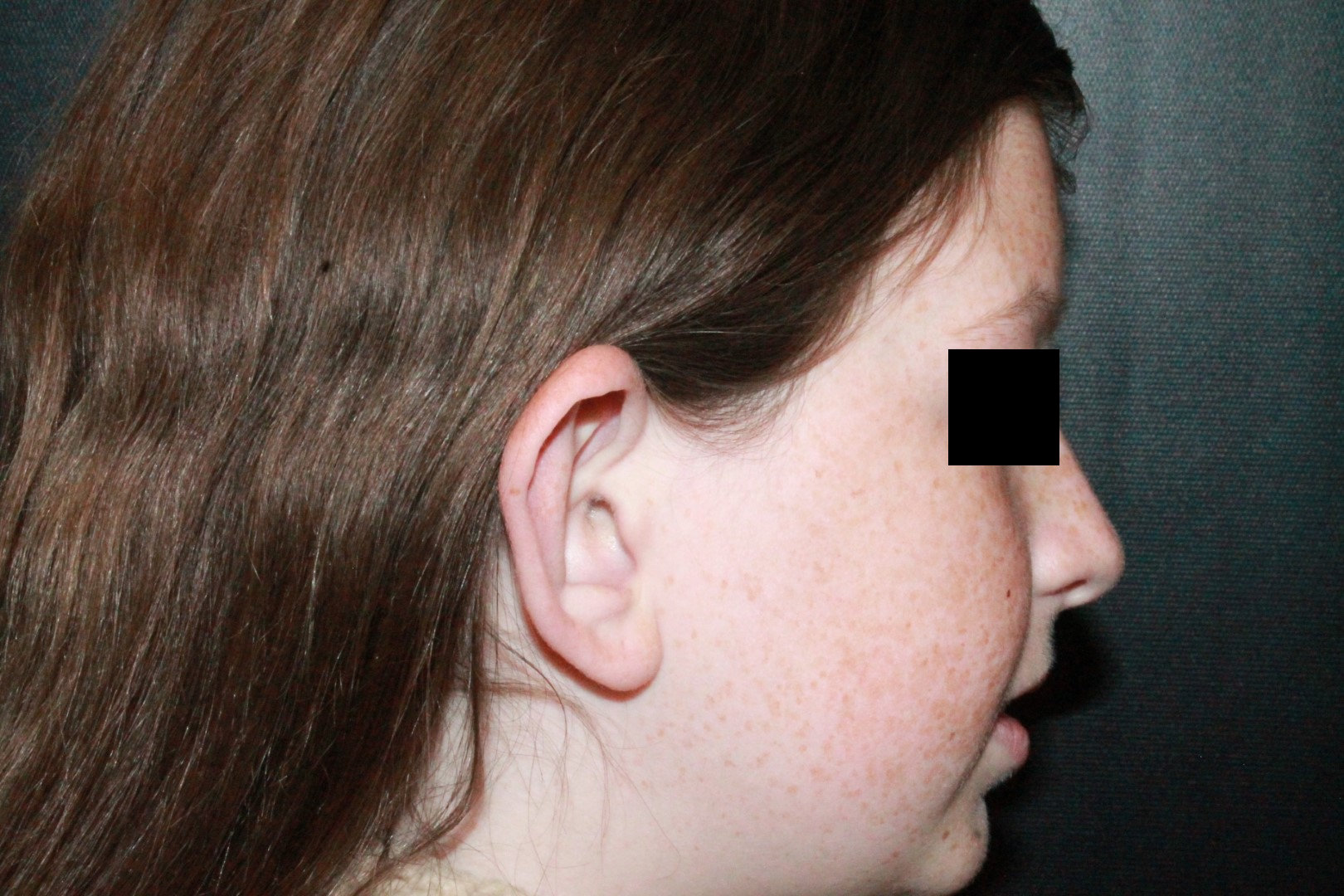 Otoplasty