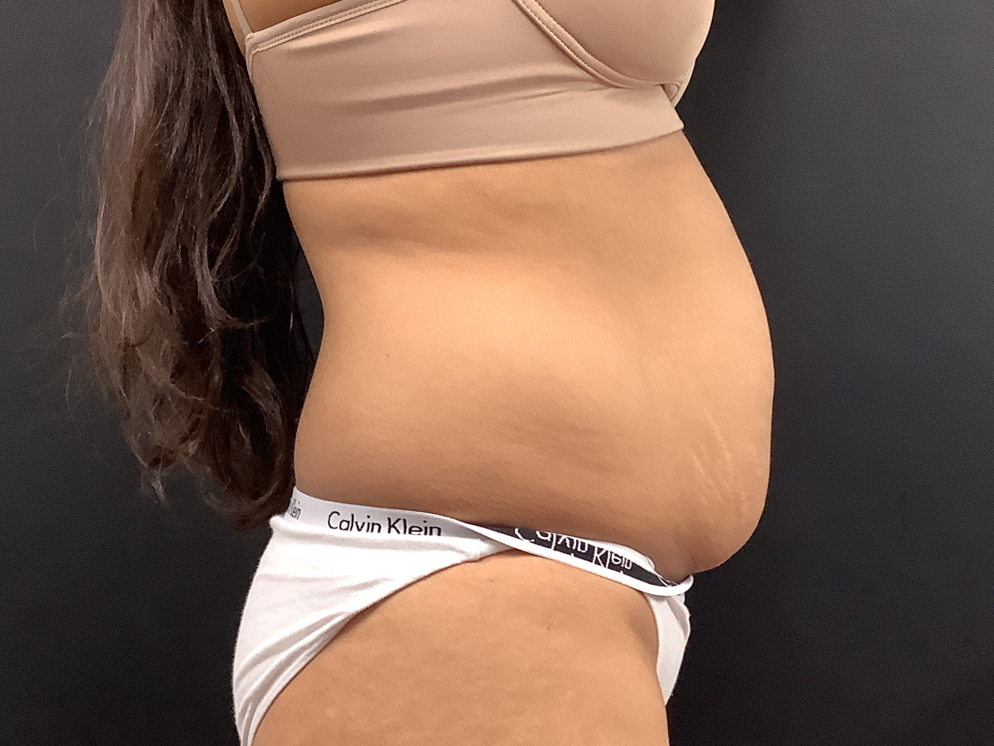 tummy tuck