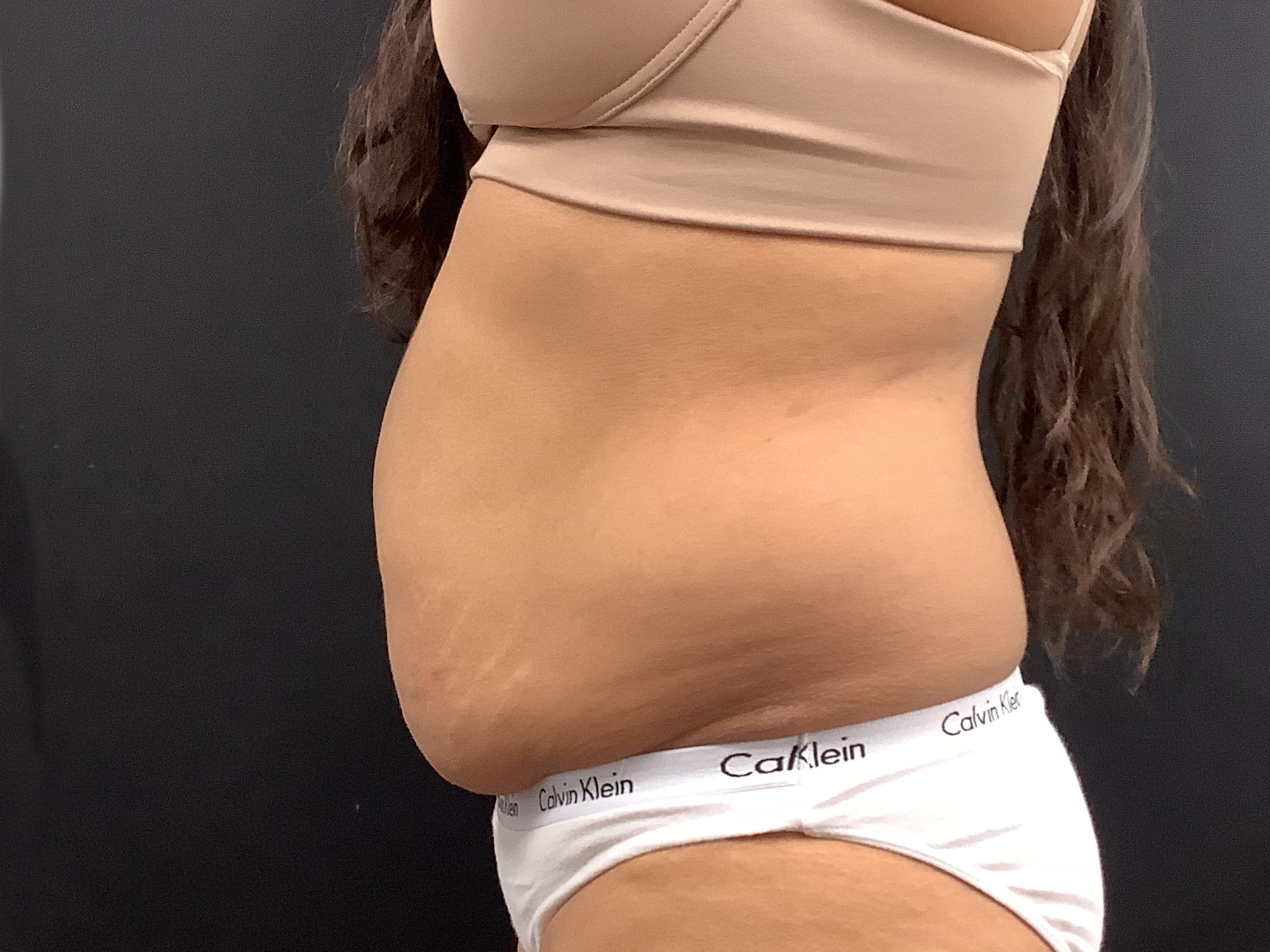 tummy tuck