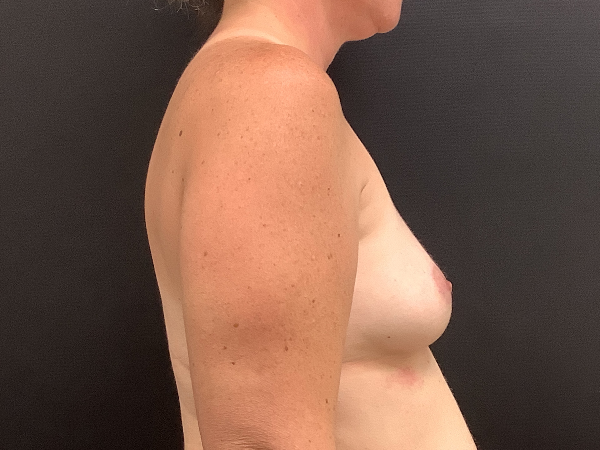 breast