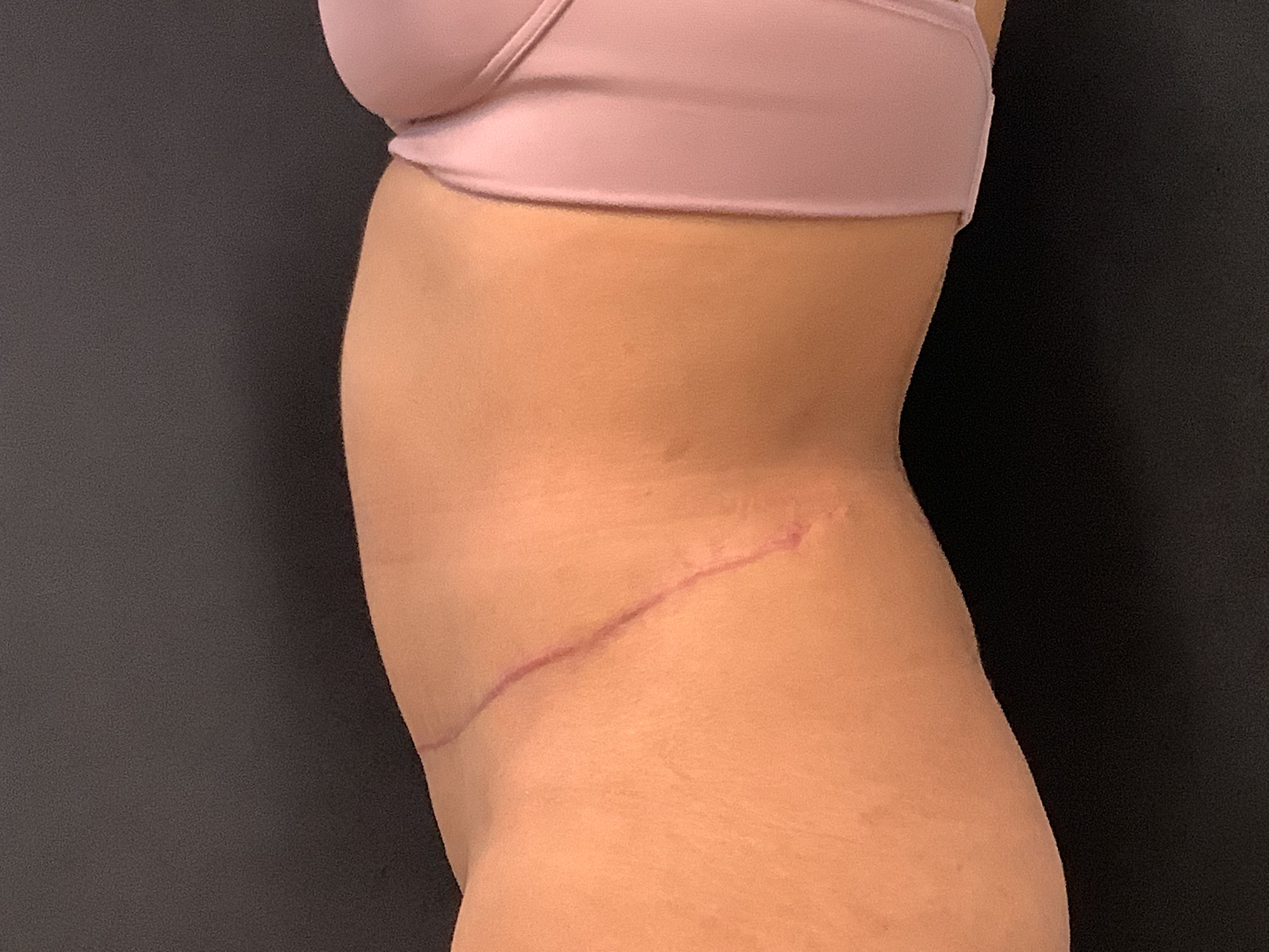 tummy tuck