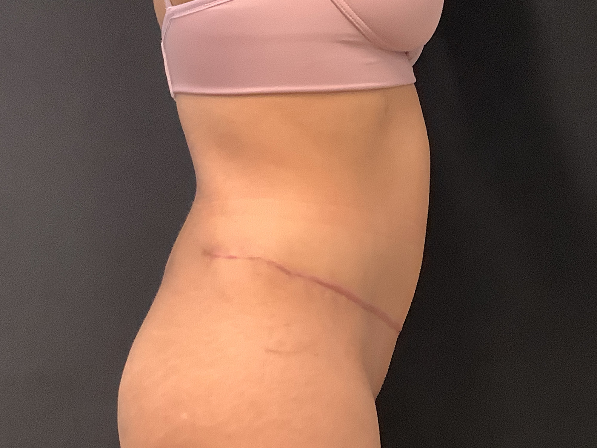 tummy tuck