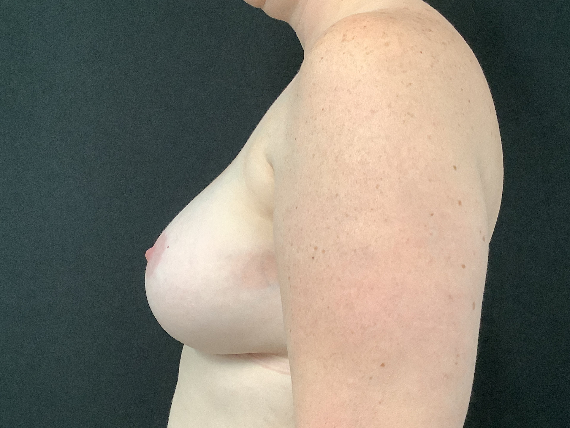 breast