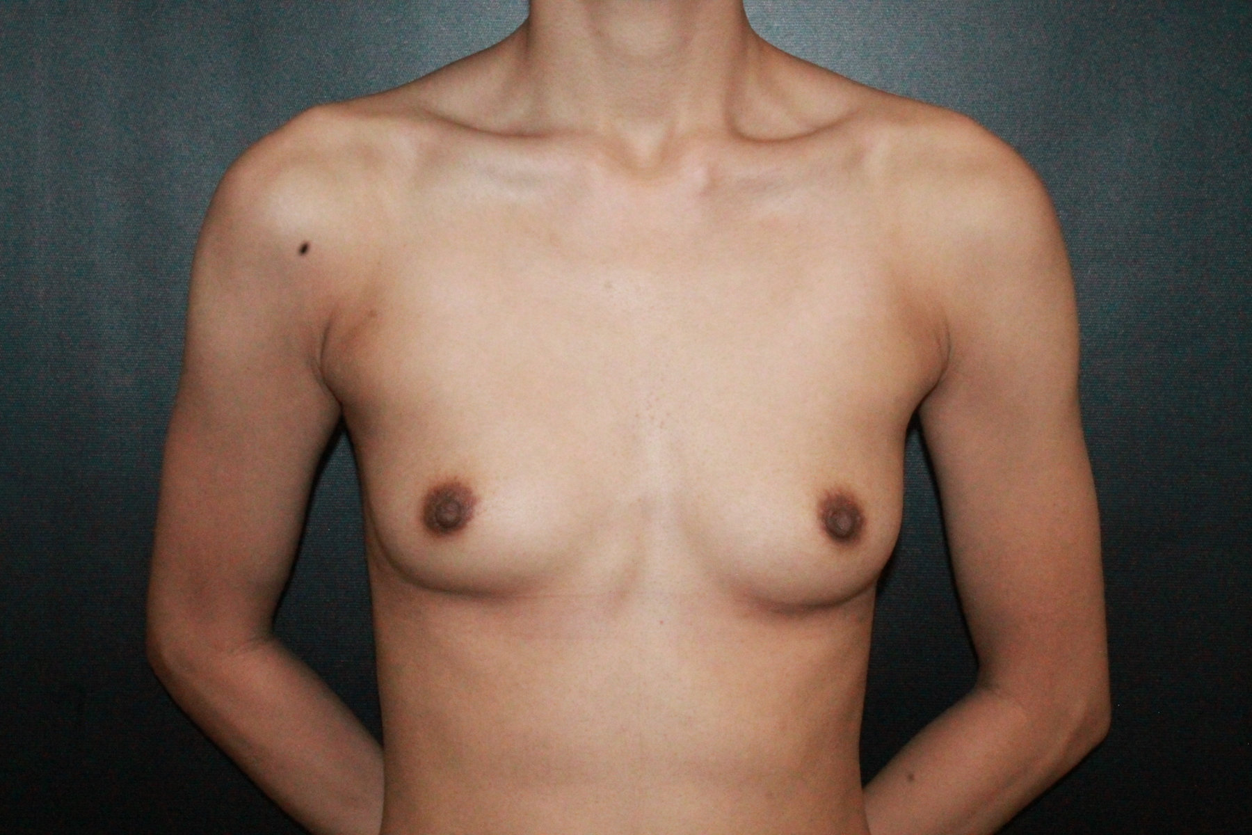 top surgery