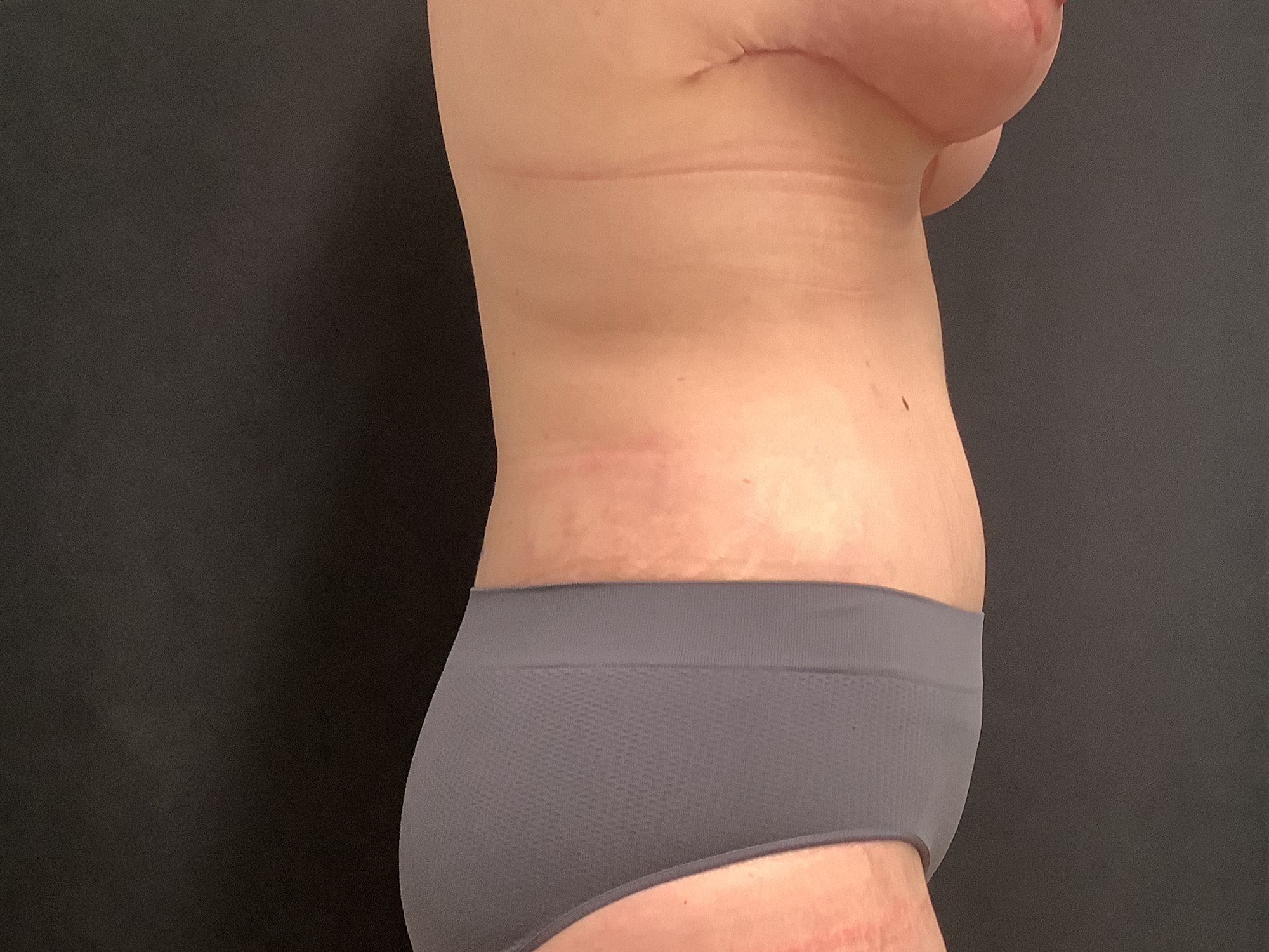 Breast Lift and Tummy Tuck