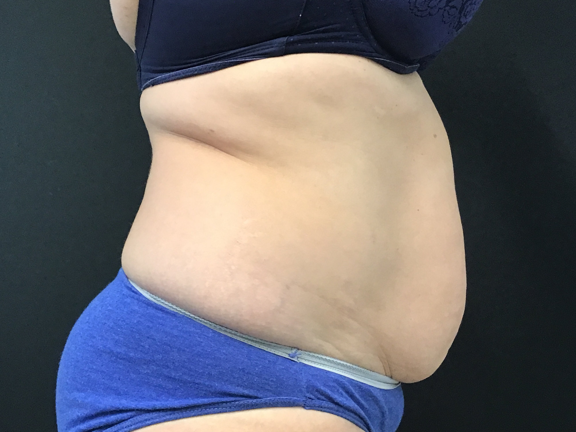 tummy tuck