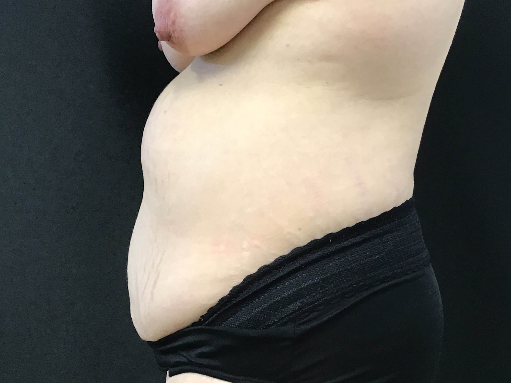 Breast Lift and Tummy Tuck