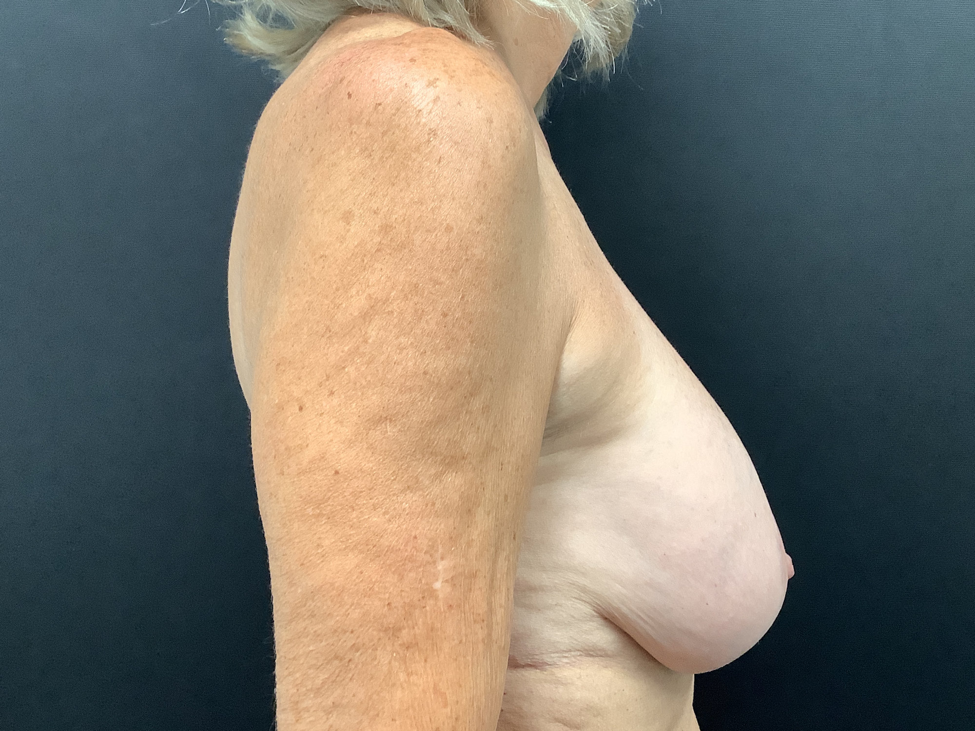 Breast Lift with Implant Removal