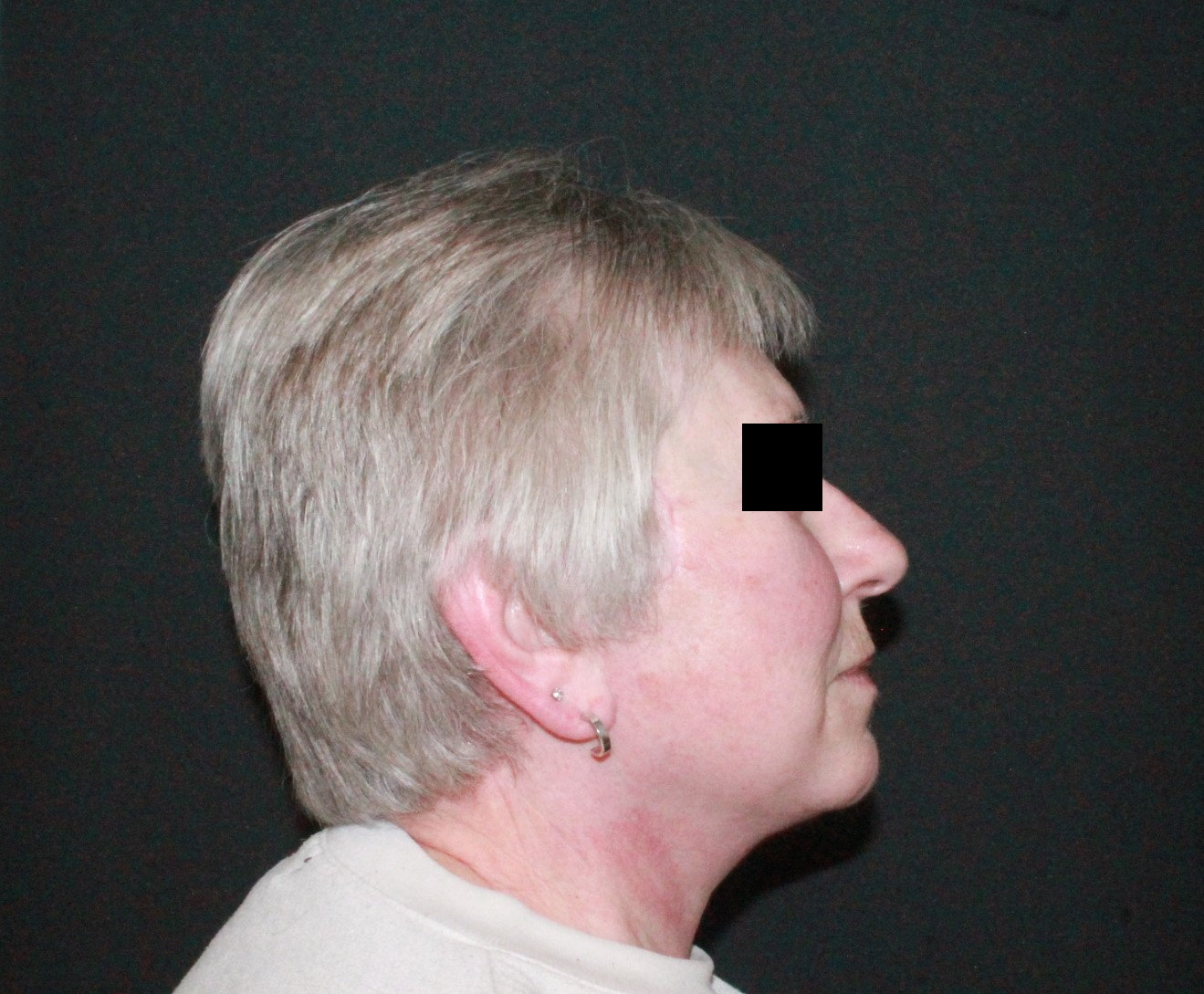 Facelift