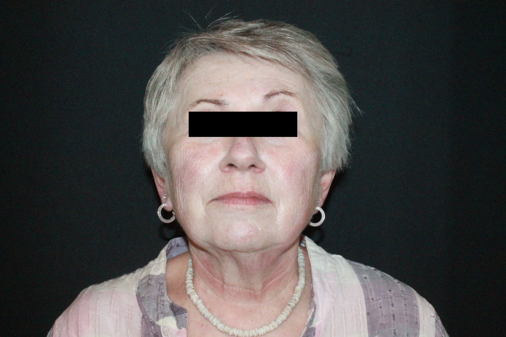 Facelift