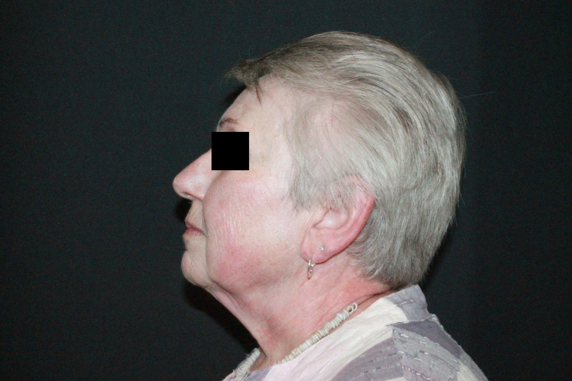 Facelift