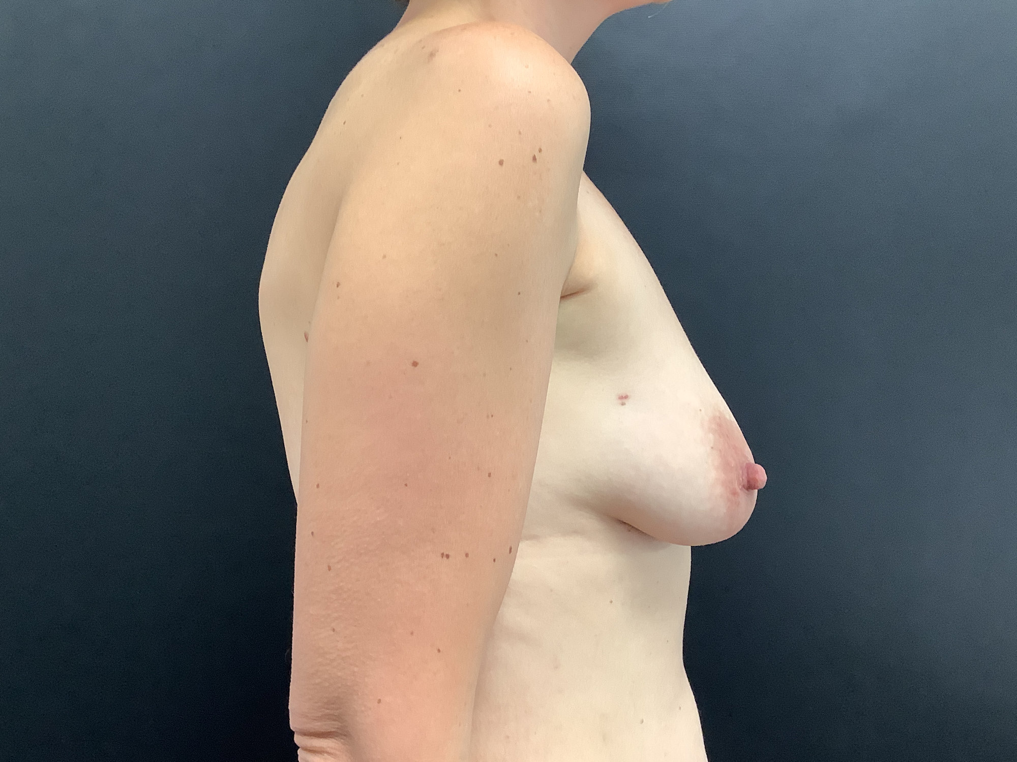 Bilateral Nipple-Sparing Breast Reconstruction