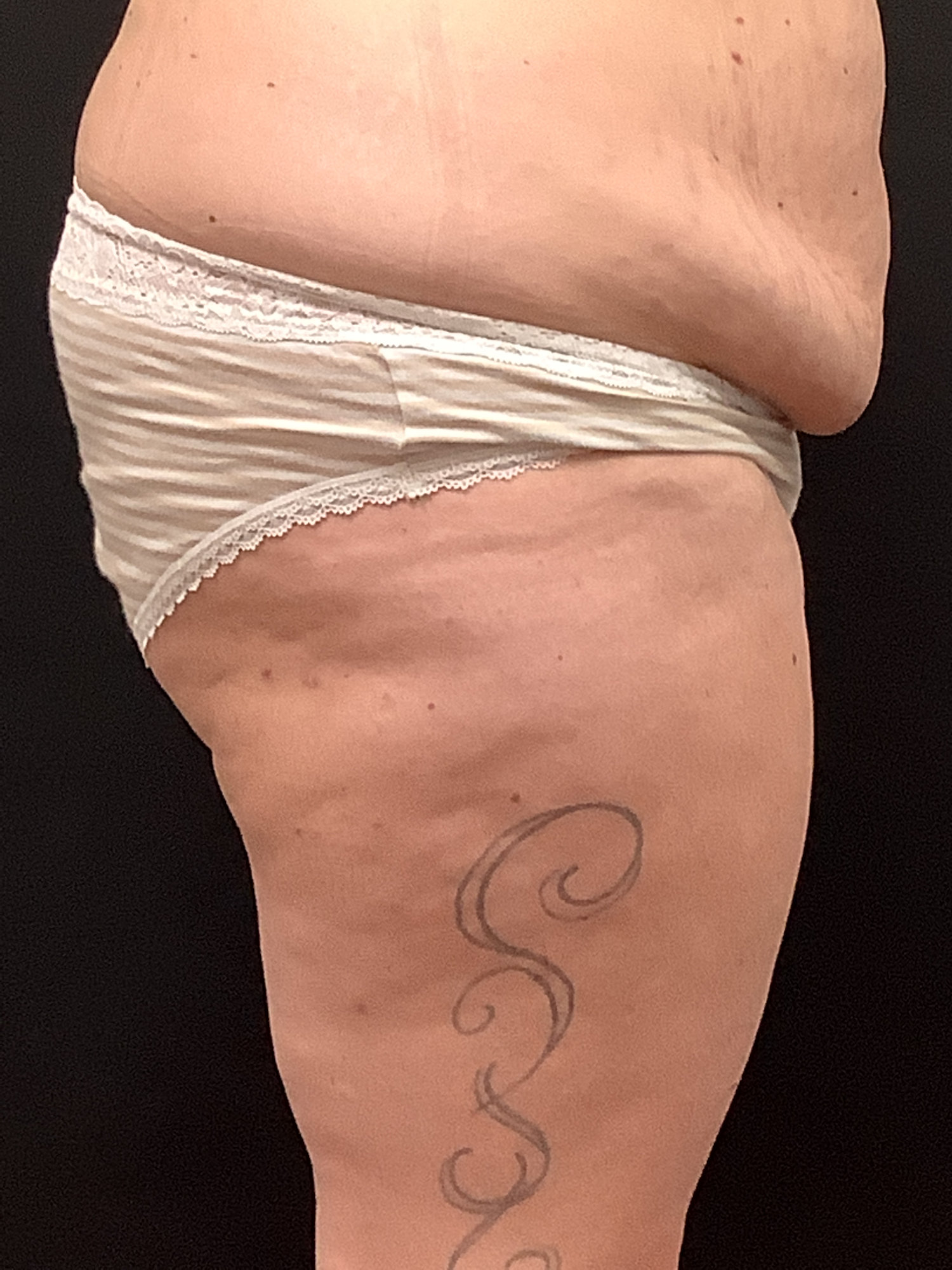 Mastopexy, Abdominoplasty with Liposuction, and Brazilian Butt Augmentation