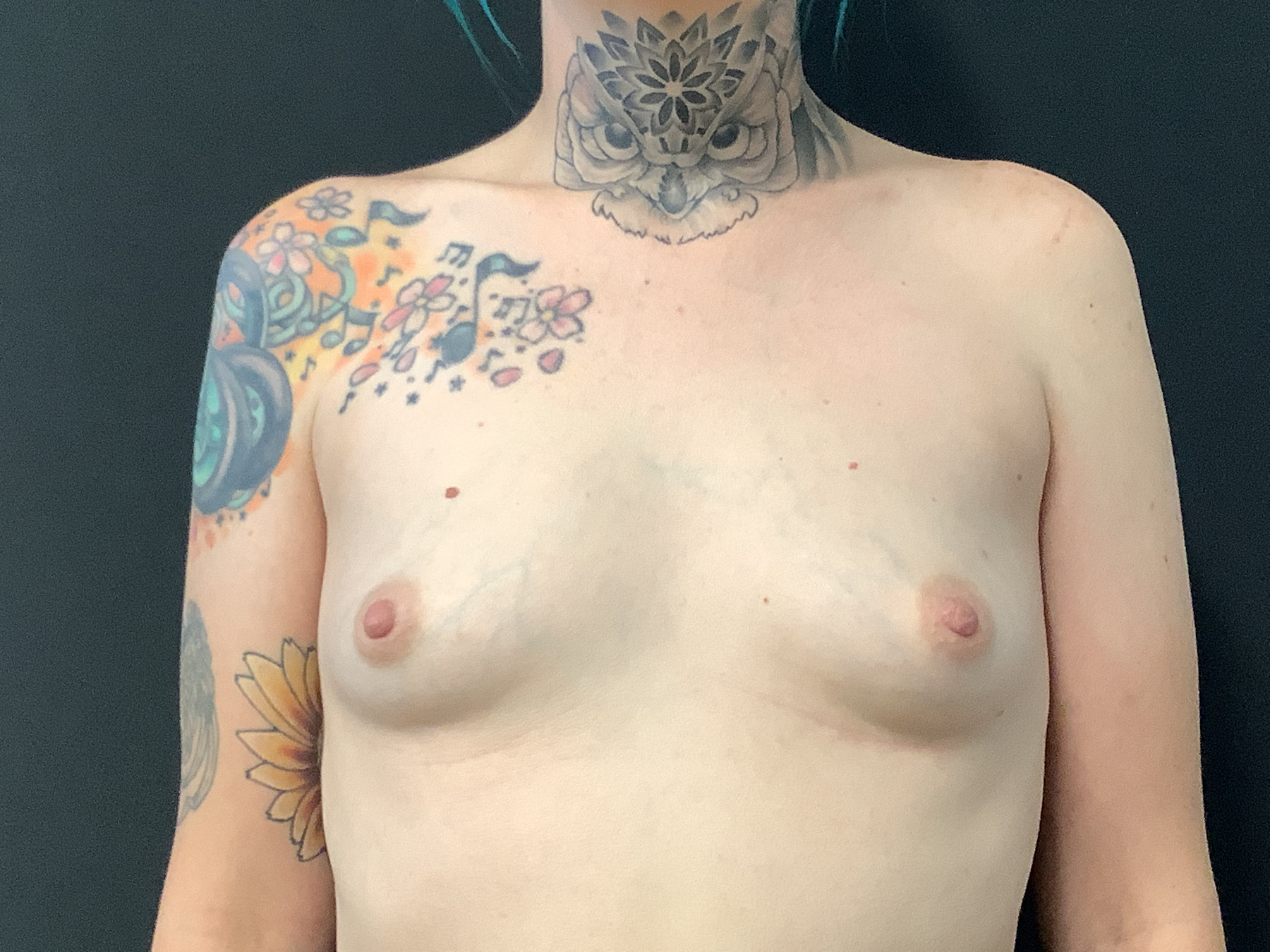 Reconstruction of bilateral breasts with placement of tissue expanders to silicone implants
